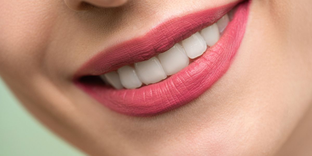 Koliko traju zubne ljuskice: Sve što trebate znati 