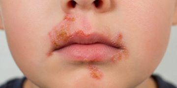 Ovako izgleda impetigo: Zašto se infekcija javlja svakoga ljeta, ima li veze s morem i kako je spriječiti?